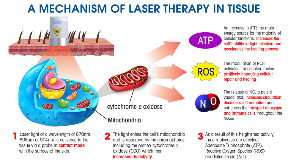 How Laser Therapy Works